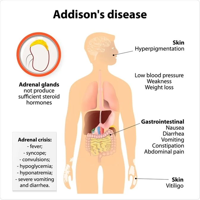 Addison disease