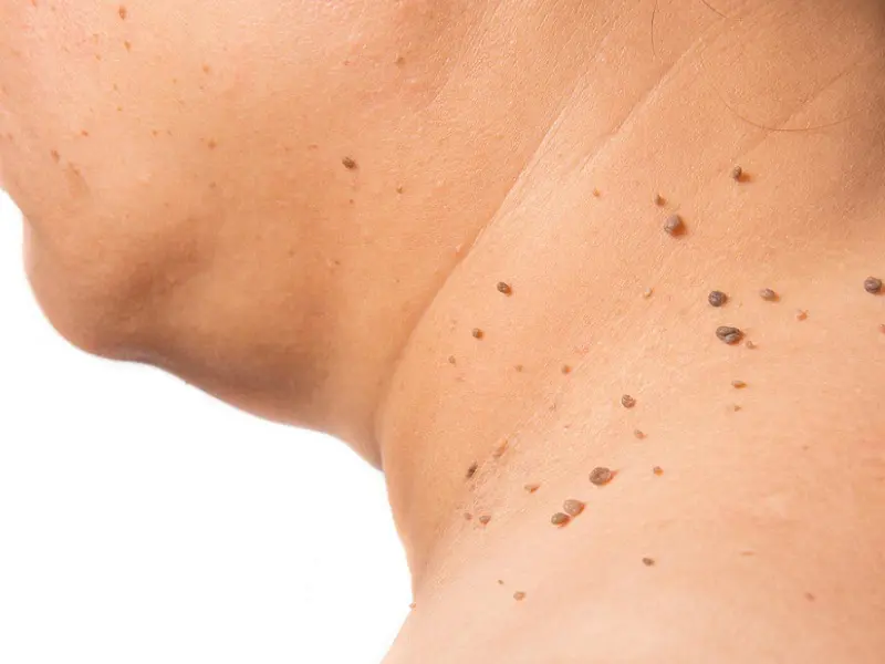 SKIN TAG: ALL YOU NEED TO KNOW ABOUT